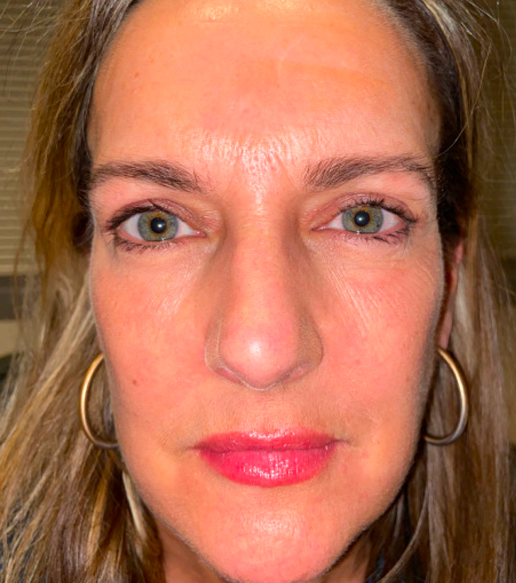 Upper Blepharoplasty with Full Face CO2 Laser Resurfacing After