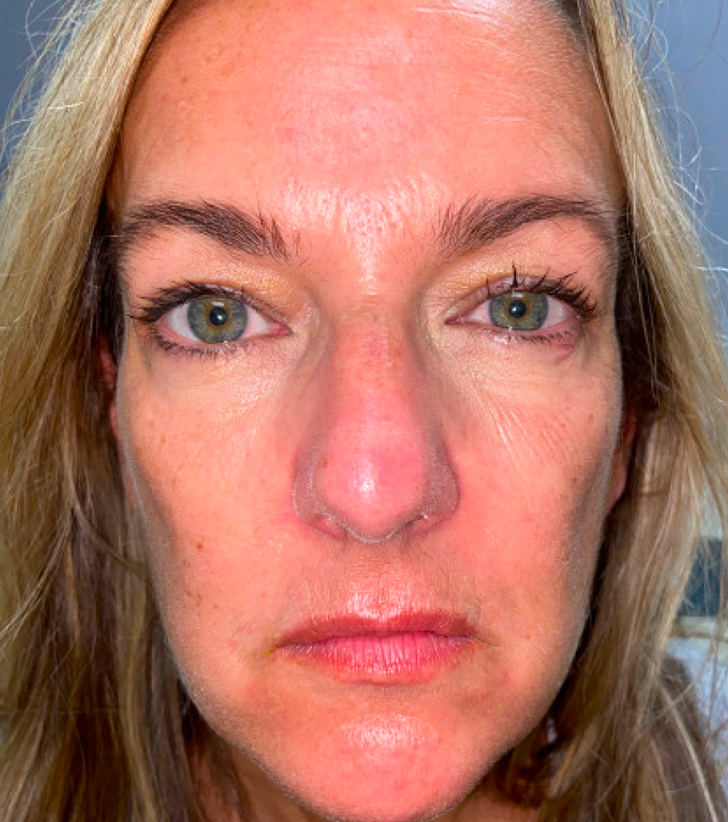 Upper Blepharoplasty with Full Face CO2 Laser Resurfacing Before