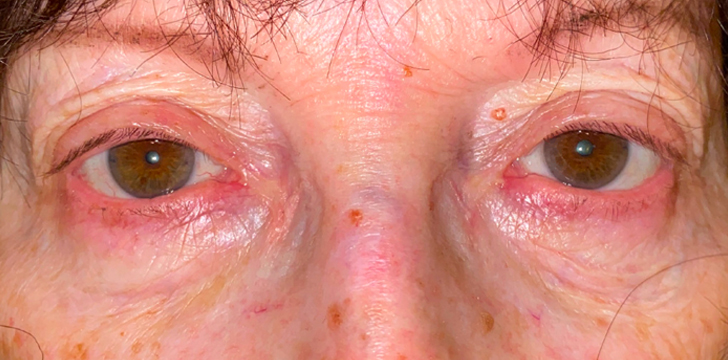 Ptosis Repair After