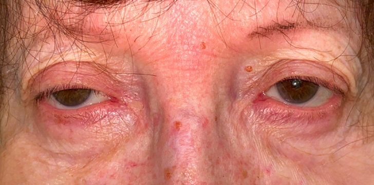 Ptosis Repair Before
