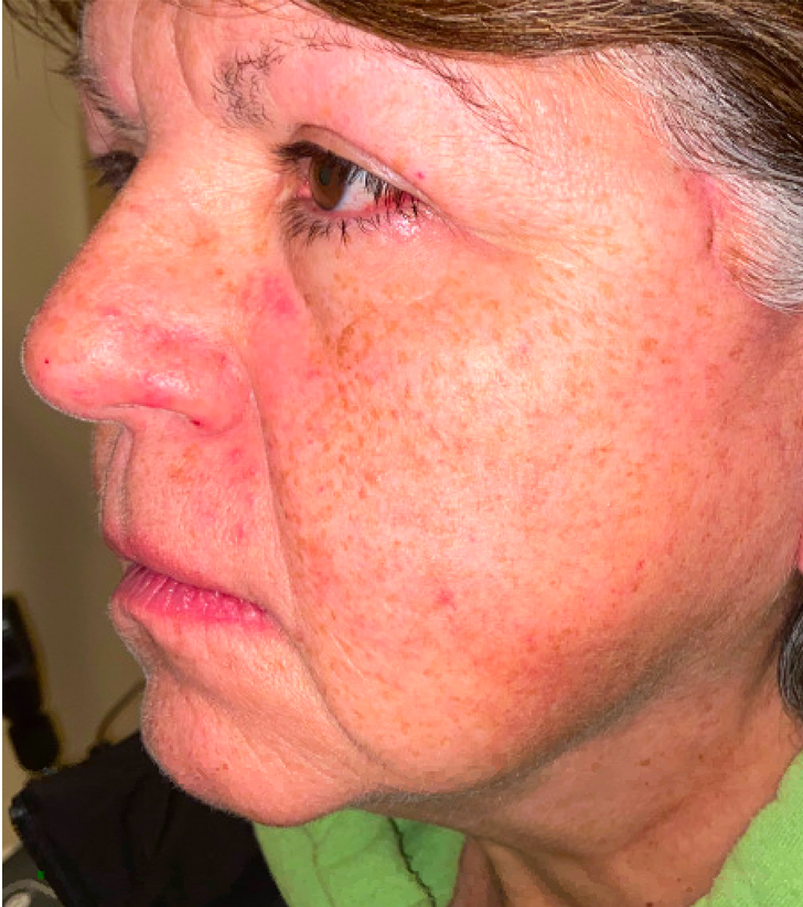 Facelift with Upper Blepharoplasty After