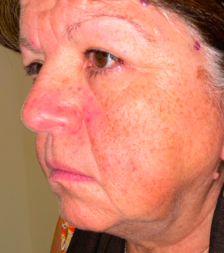 Facelift with Upper Blepharoplasty Before