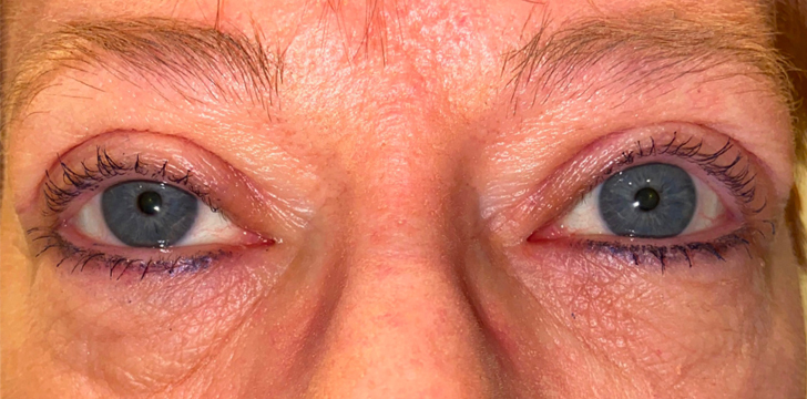 Ptosis Repair and Upper Blepharoplasty After