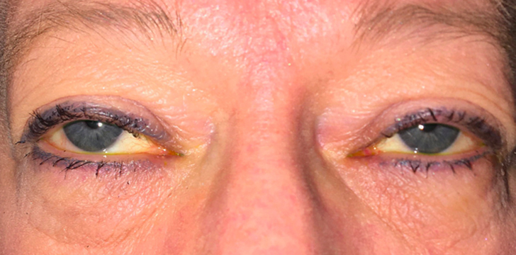 Ptosis Repair and Upper Blepharoplasty Before