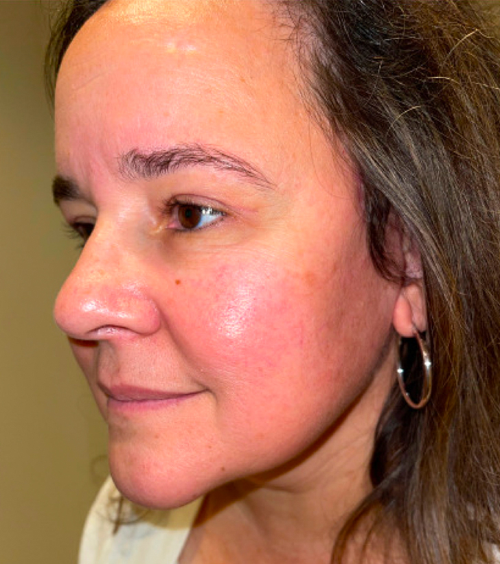 Facelift with Upper Blepharoplasty After