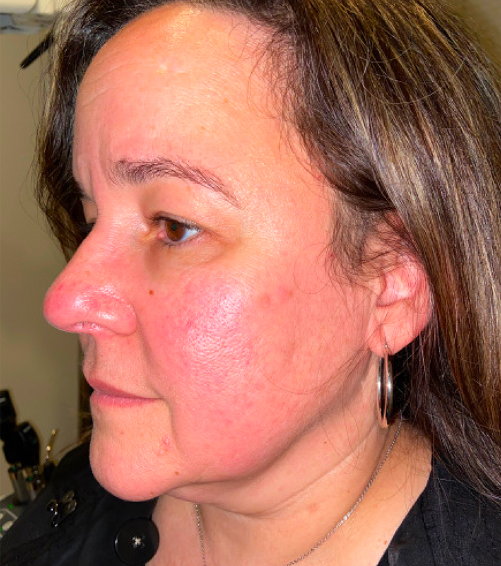 Facelift with Upper Blepharoplasty Before