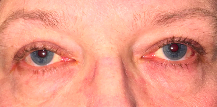 Ptosis Repair and Upper Blepharoplasty Before