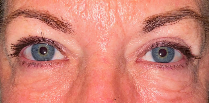 Ptosis Repair and Upper Blepharoplasty After
