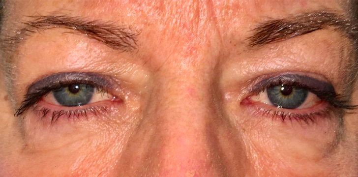 Ptosis Repair and Upper Blepharoplasty Before