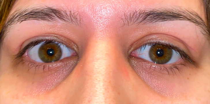 Upper Eyelid Retraction Repair After