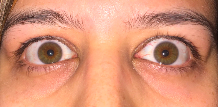 Upper Eyelid Retraction Repair Before