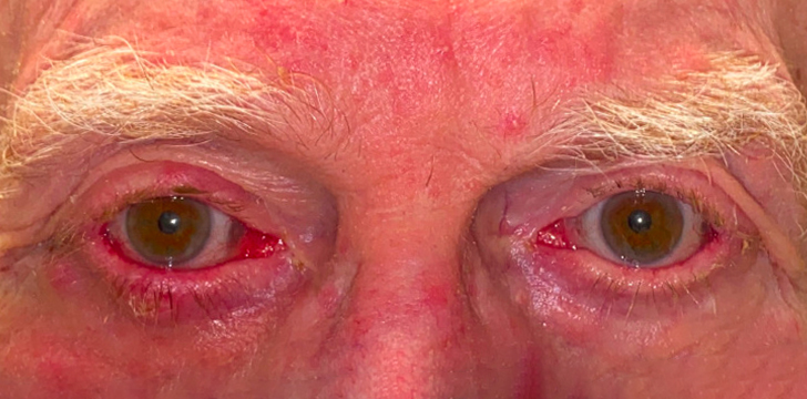 Ectropion Repair After