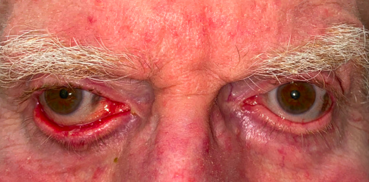 Ectropion Repair Before