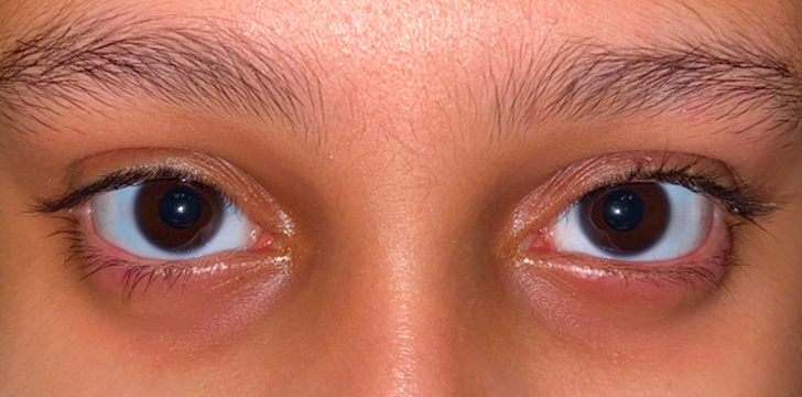 Eyelid Lesion Removal After