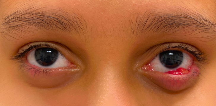 Eyelid Lesion Removal Before