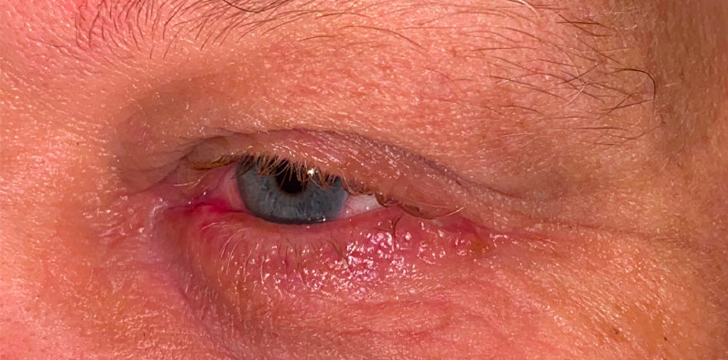 Eyelid Lesion Removal After
