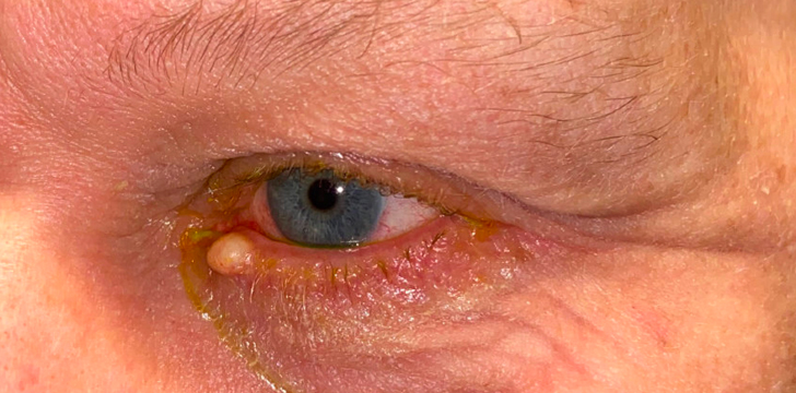 Eyelid Lesion Removal Before