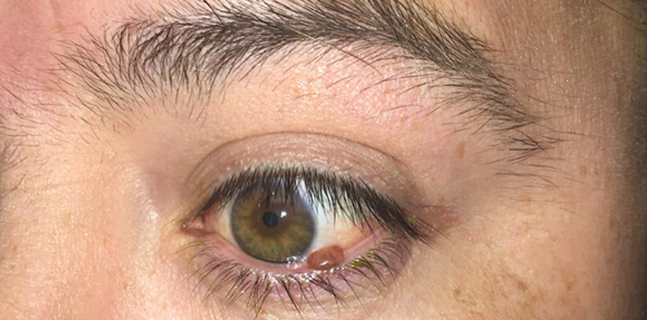 Eyelid Mole Removal Before