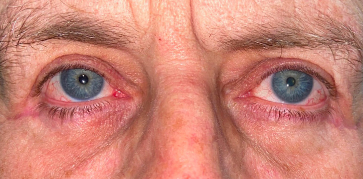 Four Lid Blepharoplasty and Midface (Cheek) Lift After