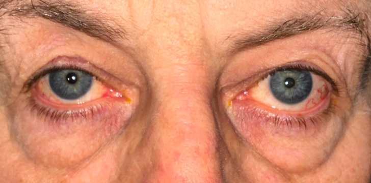 Four Lid Blepharoplasty and Midface (Cheek) Lift Before