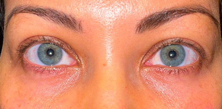 Lower Eyelid Blepharoplasty After