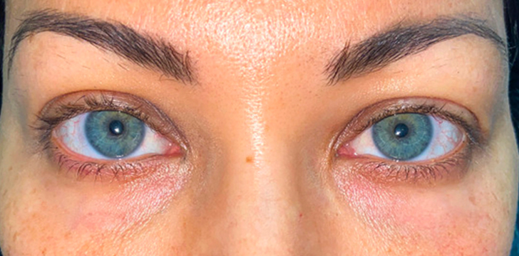 Lower Eyelid Blepharoplasty Before