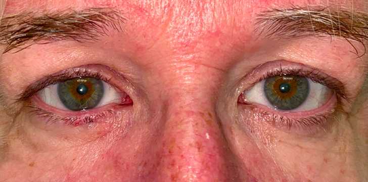 Eyelid Mole Removal After