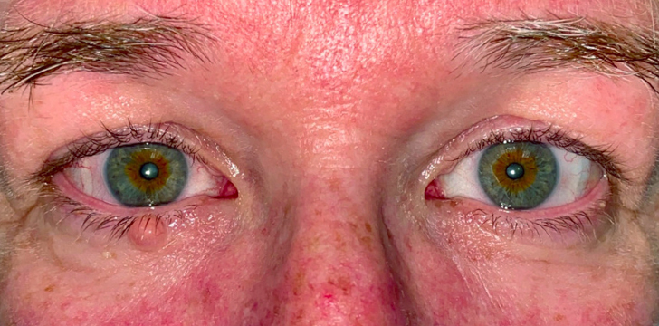 Eyelid Mole Removal Before