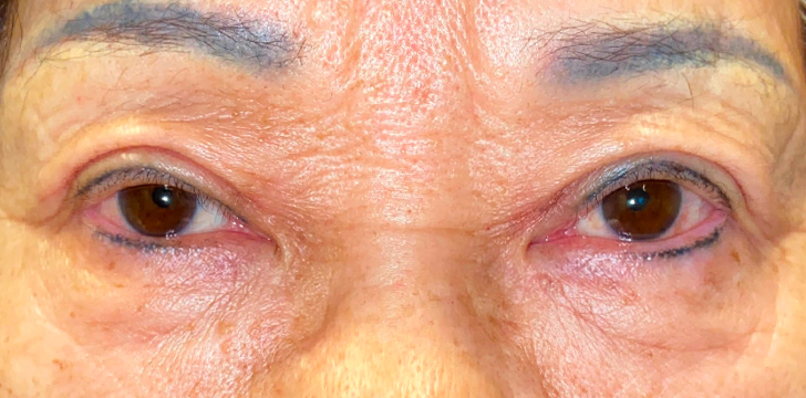 Double Eyelid Surgery After