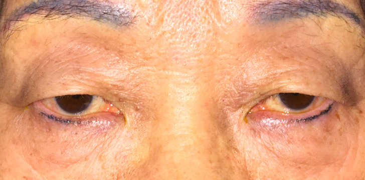 Double Eyelid Surgery Before