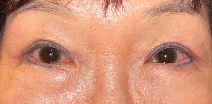 Double Eyelid Surgery After