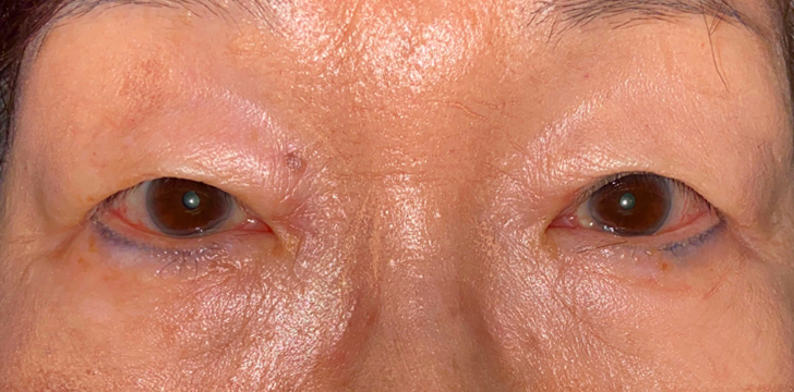 Double Eyelid Surgery Before
