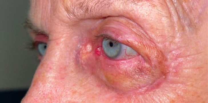 Mohs Repair (Eyelid Cancer Reconstruction) After