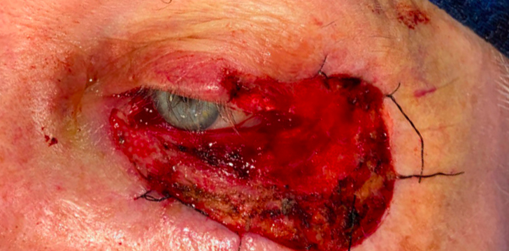 Mohs Repair (Eyelid Cancer Reconstruction) Before