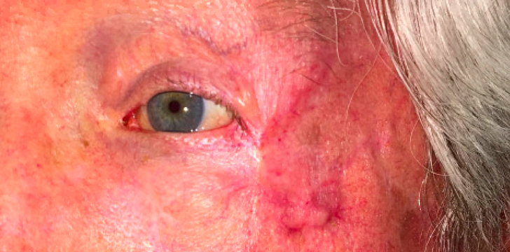 Mohs Repair (Eyelid Cancer Reconstruction) After