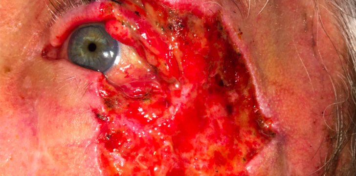 Mohs Repair (Eyelid Cancer Reconstruction) Before