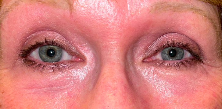 Four Lid Blepharoplasty with Periocular CO2 Laser Resurfacing After