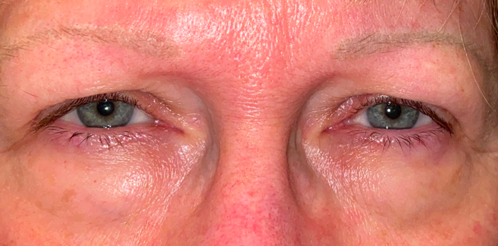 Four Lid Blepharoplasty with Periocular CO2 Laser Resurfacing Before