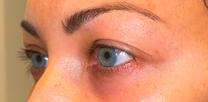 Lower Eyelid Blepharoplasty After