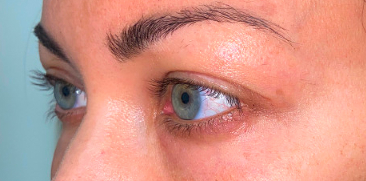 Lower Eyelid Blepharoplasty Before