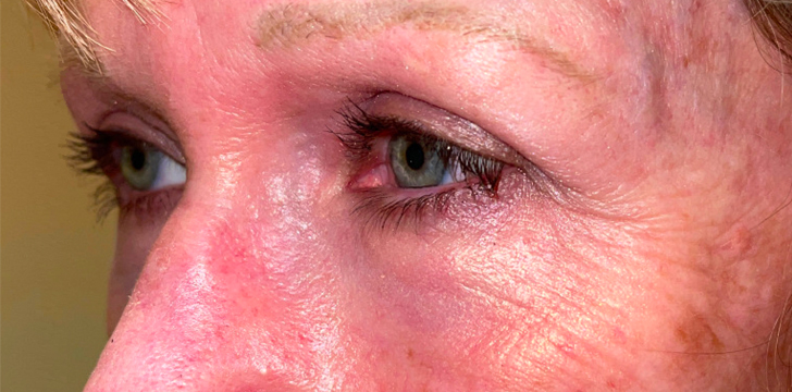 Four Lid Blepharoplasty with Periocular CO2 Laser Resurfacing After