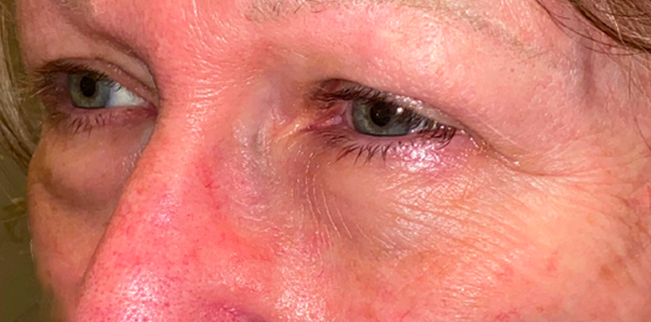 Four Lid Blepharoplasty with Periocular CO2 Laser Resurfacing Before