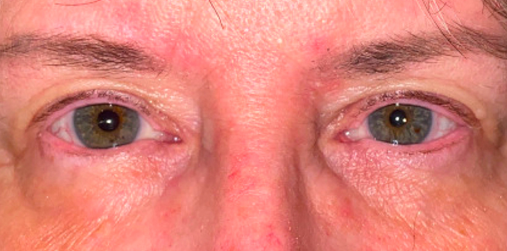 Orbital Tumor After