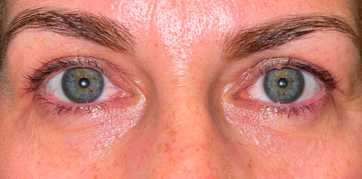Upper Eyelid Blepharoplasty After