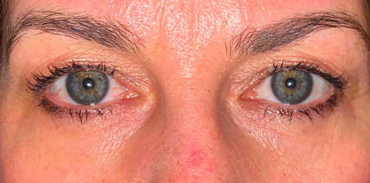 Upper Eyelid Blepharoplasty Before