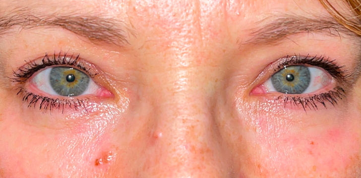 Four Lid Blepharoplasty with Periocular CO2 Laser Resurfacing After