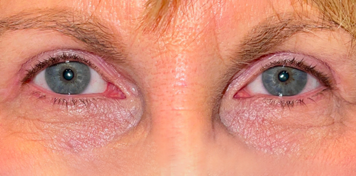 Upper Eyelid Blepharoplasty After
