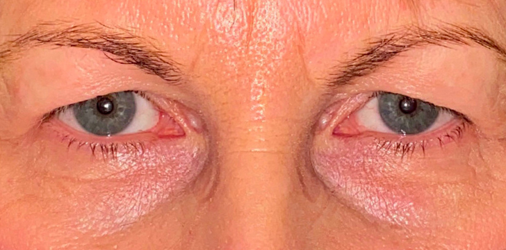 Upper Eyelid Blepharoplasty Before