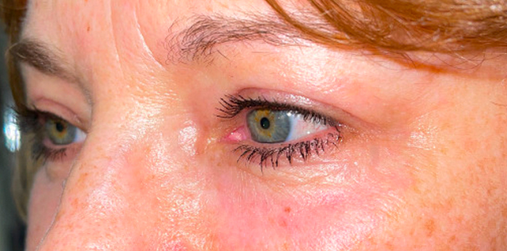 Four Lid Blepharoplasty with Periocular CO2 Laser Resurfacing After