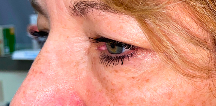 Four Lid Blepharoplasty with Periocular CO2 Laser Resurfacing Before